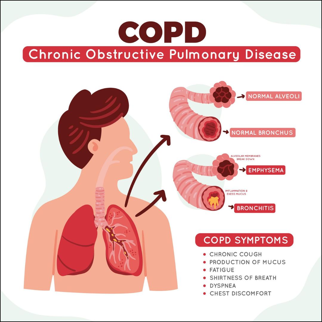 longen met COPD aandoening uitgelegd